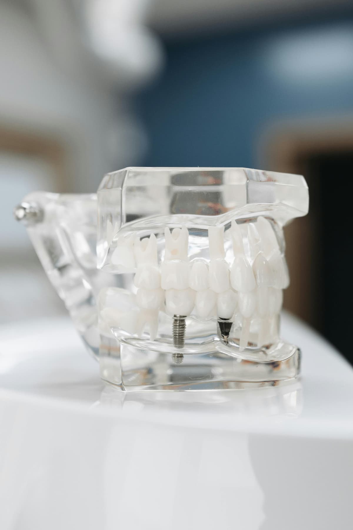 Dental Implants