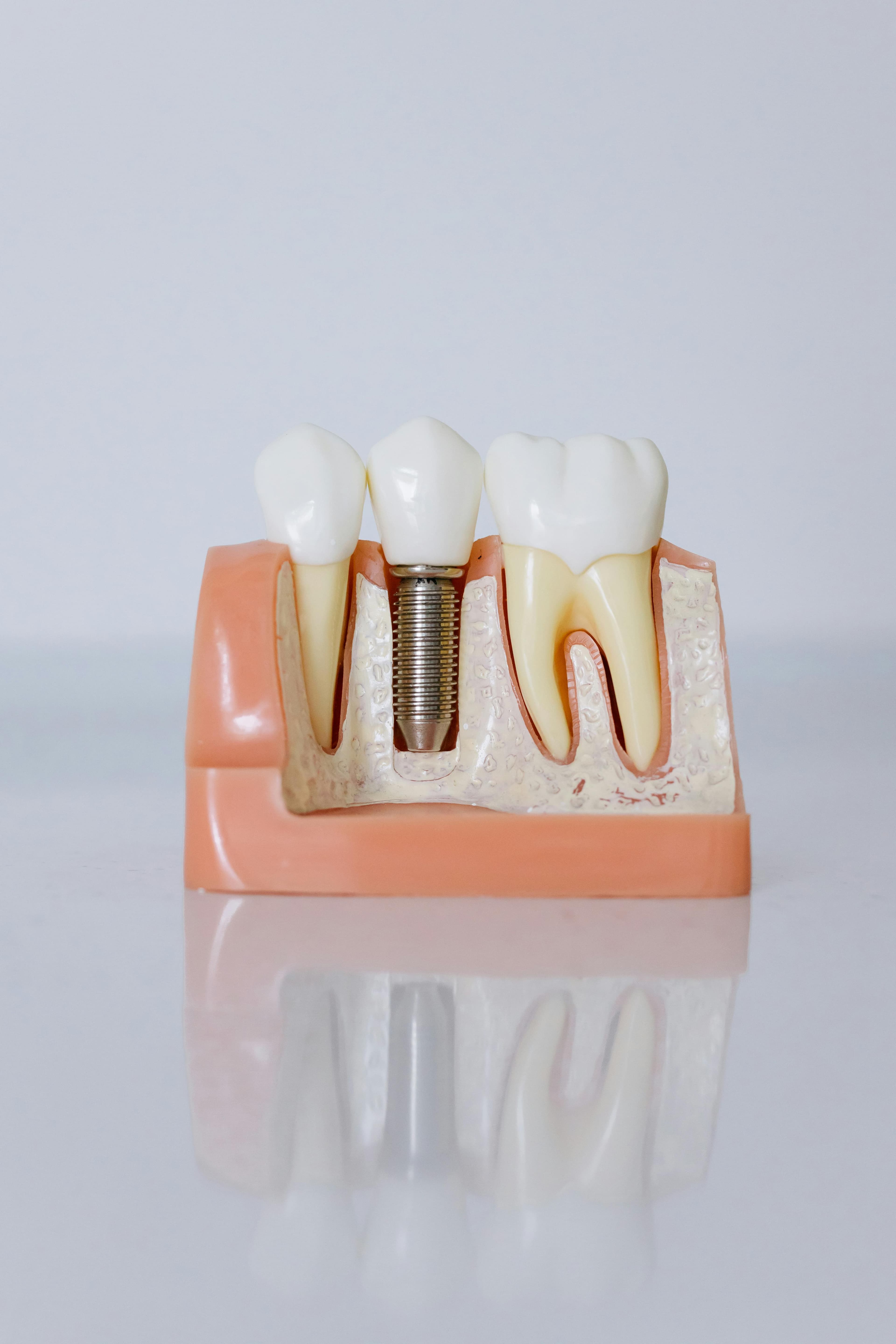 Implants