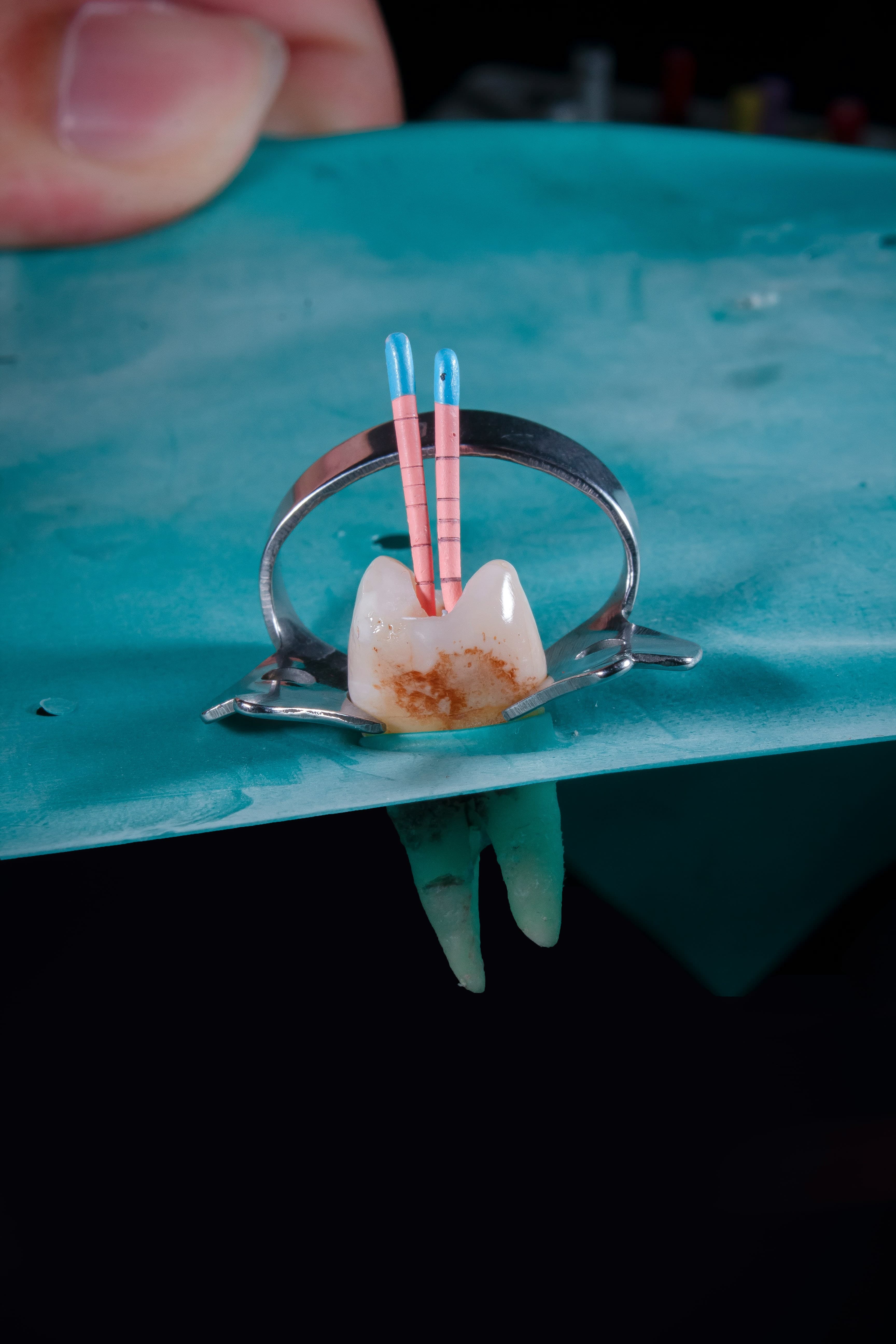 Root Canal Treatment