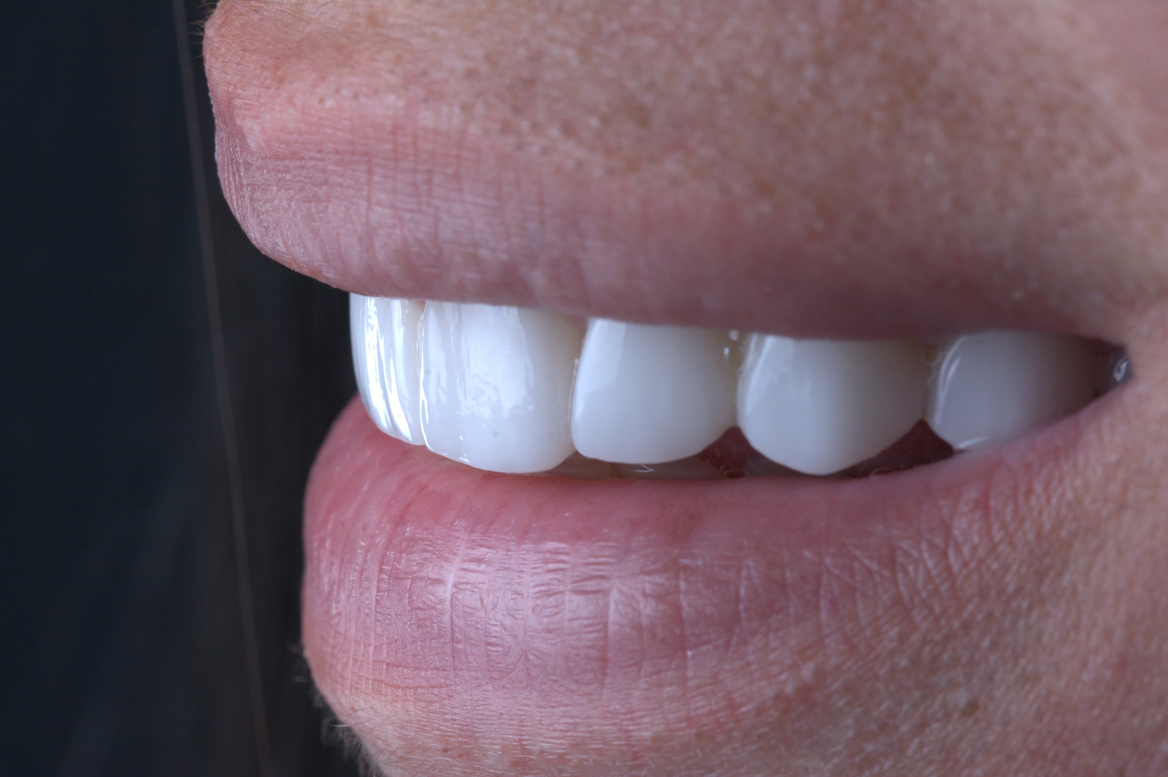 Teeth Bleaching